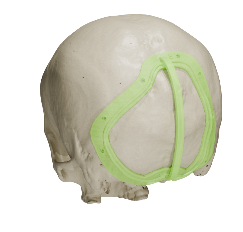Cranial Reconstruction