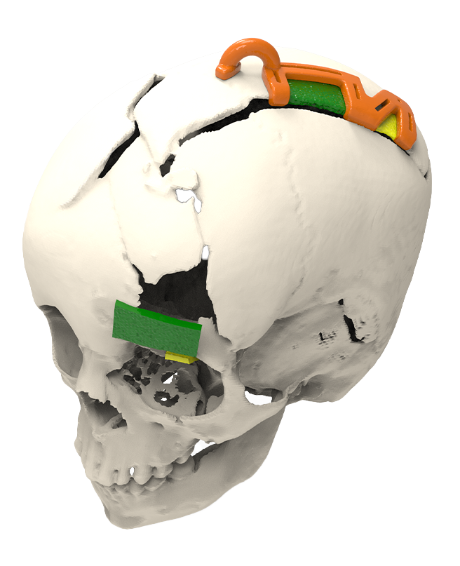 Cranial Reconstruction