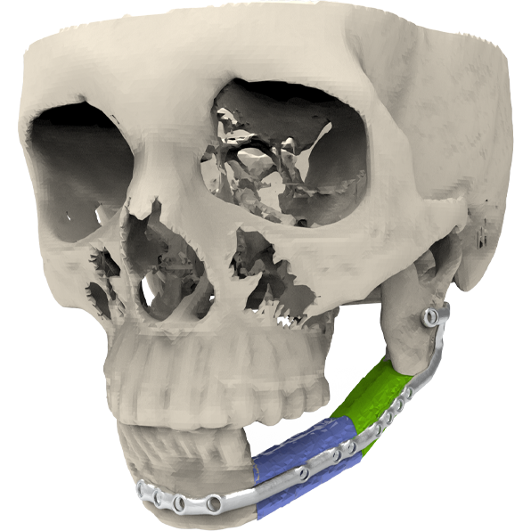 Cranial Reconstruction