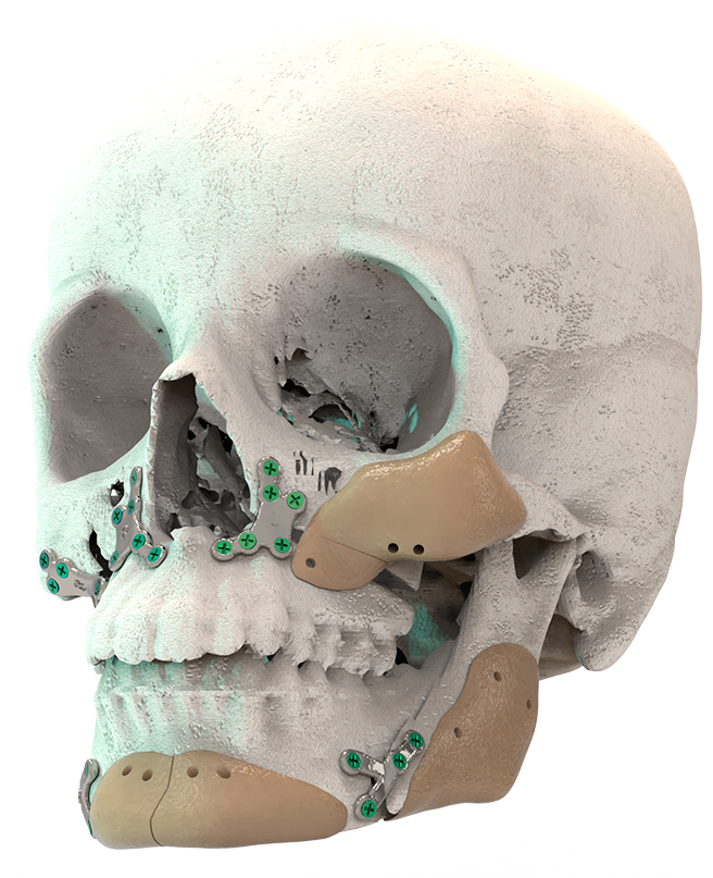 Cranial Reconstruction