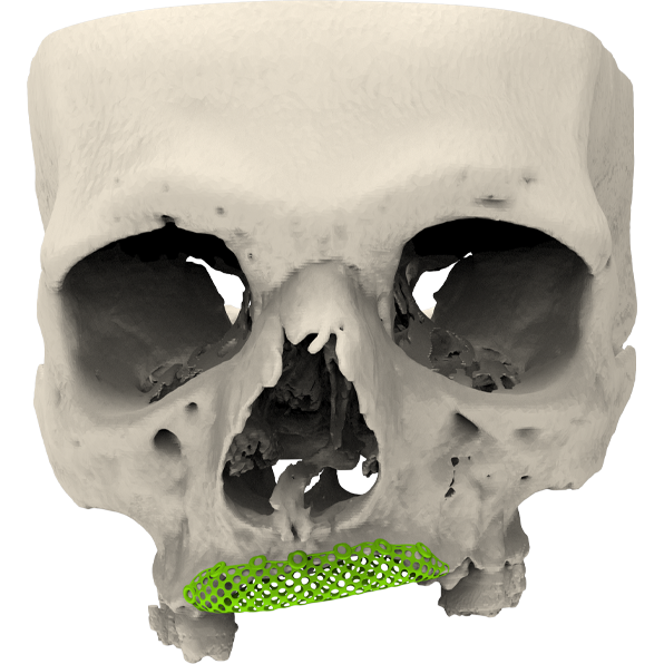 Cranial Reconstruction