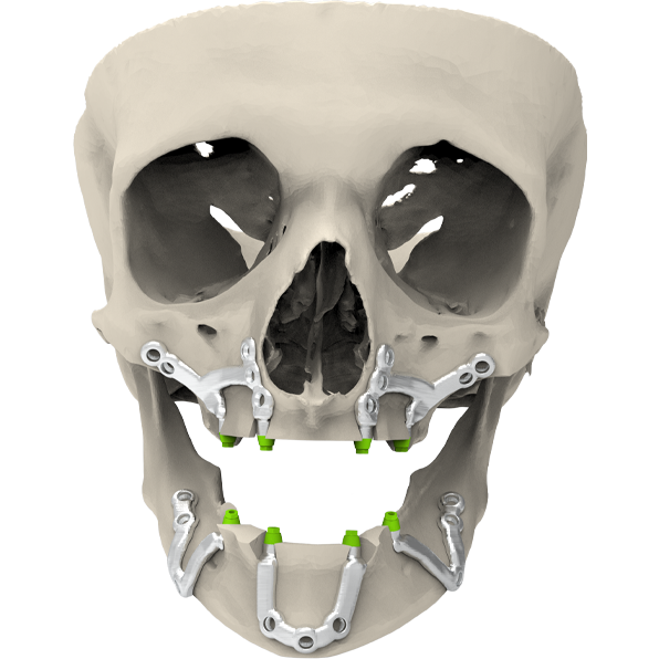 Cranial Reconstruction